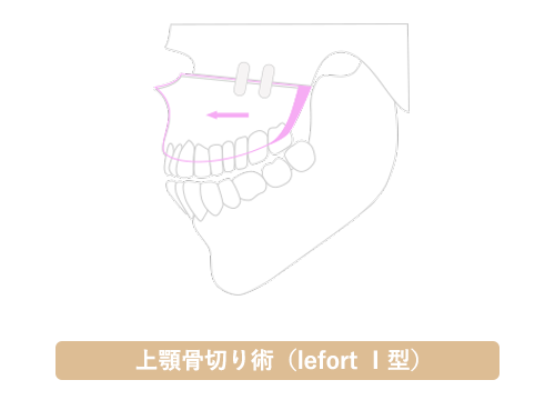 外科矯正 博多矯正歯科 Kitte博多院