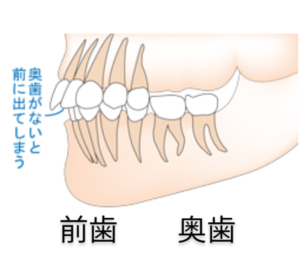 フレアーアウトは矯正だけでは治らない！？ | 博多矯正歯科 KITTE博多院