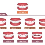 噛み合わせ　矯正