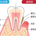 歯周病